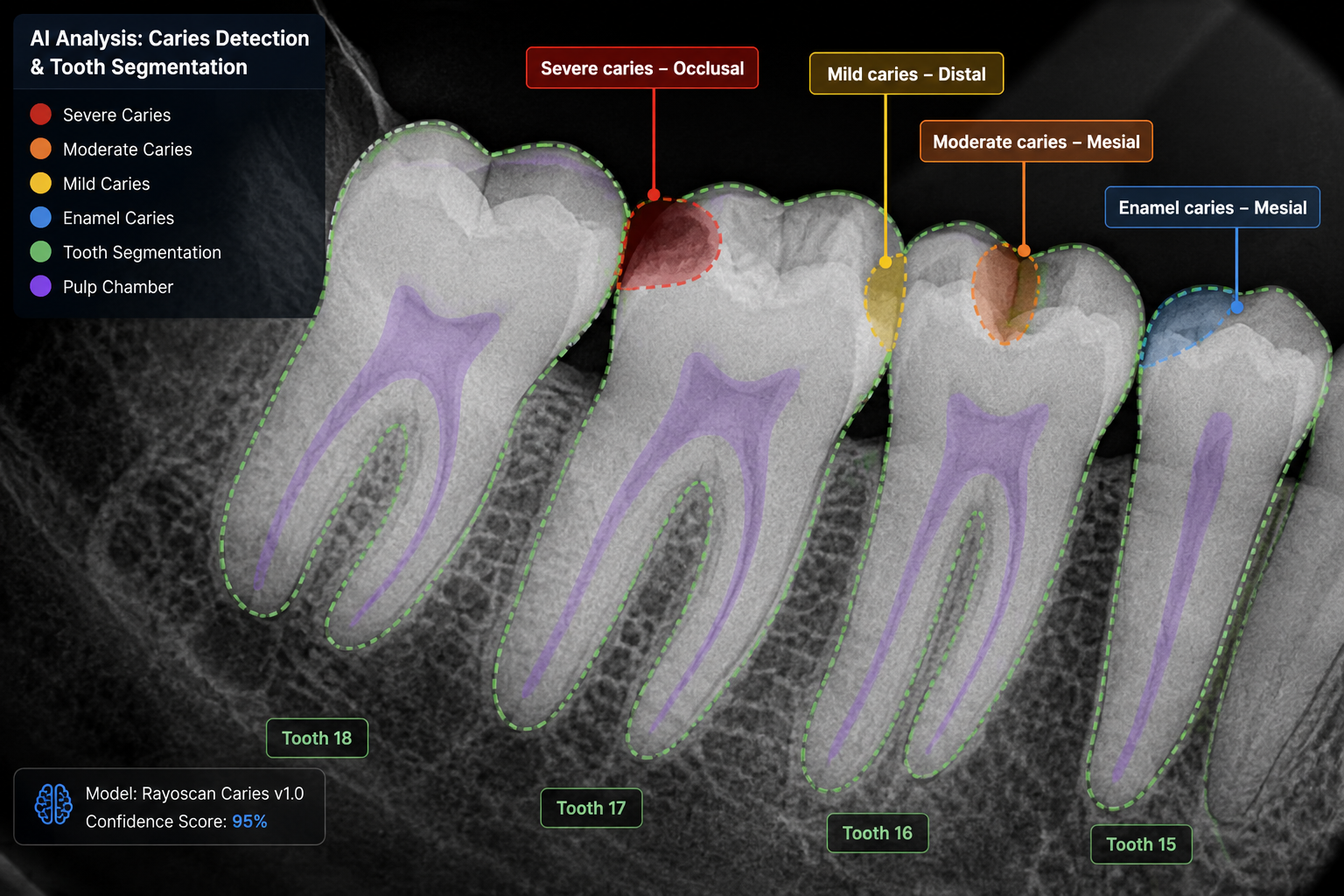 Caries detection and tooth segmentation
