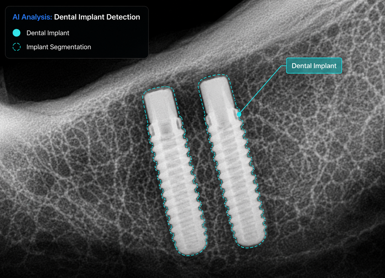 Dental implant detection