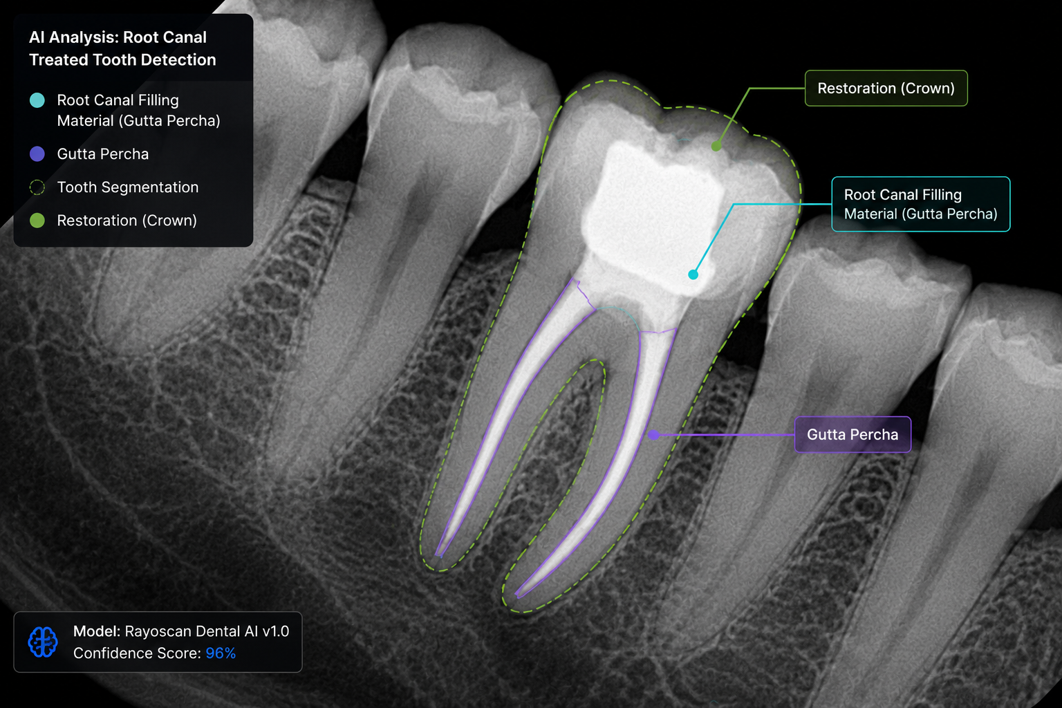 Root canal treated tooth detection