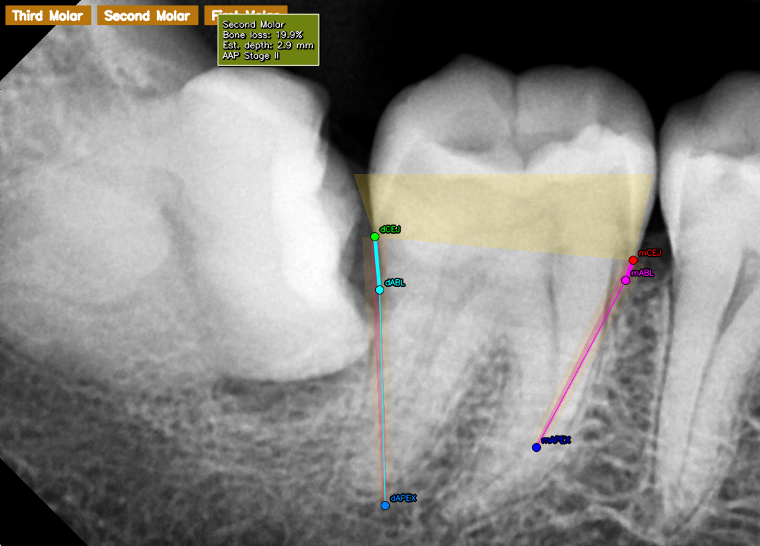 Bone loss analysis
